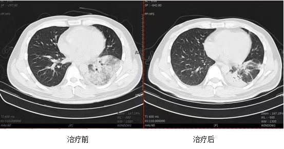 患者治疗前后肺部对比图。西南医院供图